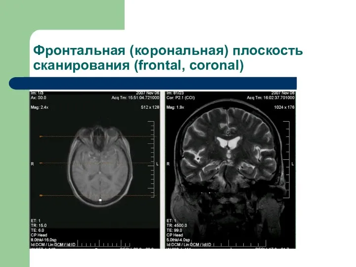 Фронтальная (корональная) плоскость сканирования (frontal, coronal)