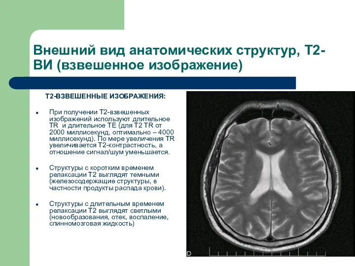 Внешний вид анатомических структур, Т2-ВИ (взвешенное изображение) Т2-ВЗВЕШЕННЫЕ ИЗОБРАЖЕНИЯ: При получении Т2-взвешенных