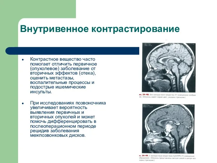 Внутривенное контрастирование Контрастное вещество часто помогает отличить первичное (опухолевое) заболевание от вторичных