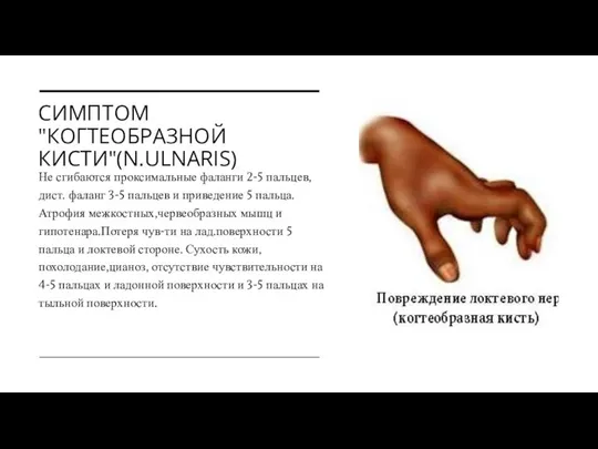 СИМПТОМ "КОГТЕОБРАЗНОЙ КИСТИ"(N.ULNARIS) Не сгибаются проксимальные фаланги 2-5 пальцев,дист. фаланг 3-5 пальцев