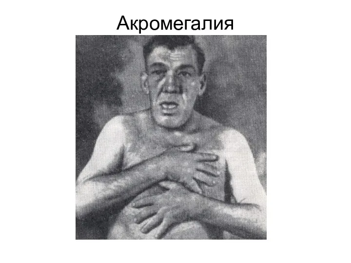 Акромегалия