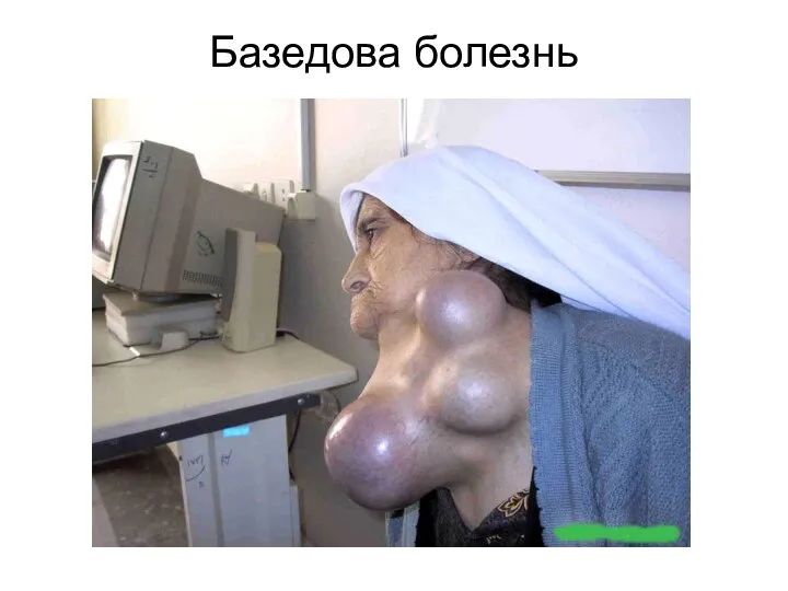 Базедова болезнь