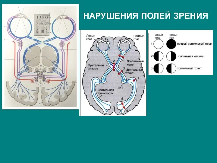 НАРУШЕНИЯ ПОЛЕЙ ЗРЕНИЯ