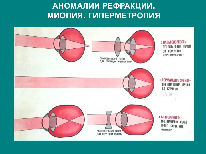 АНОМАЛИИ РЕФРАКЦИИ. МИОПИЯ. ГИПЕРМЕТРОПИЯ