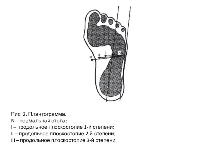 Рис. 2. Плантограмма. N – нормальная стопа; I – продольное плоскостопие 1-й