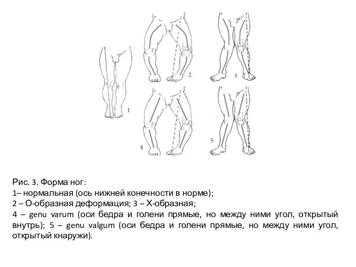 Рис. 3. Форма ног: 1– нормальная (ось нижней конечности в норме); 2