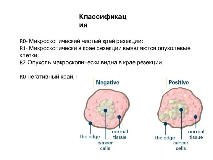 Классификация R0- Микроскопический чистый край резекции; R1- Микроскопически в крае резекции выявляются