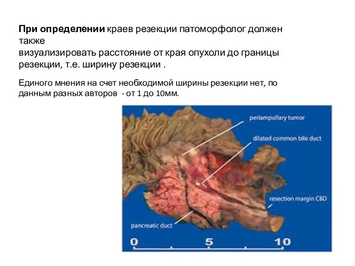 При определении краев резекции патоморфолог должен также визуализировать расстояние от края опухоли