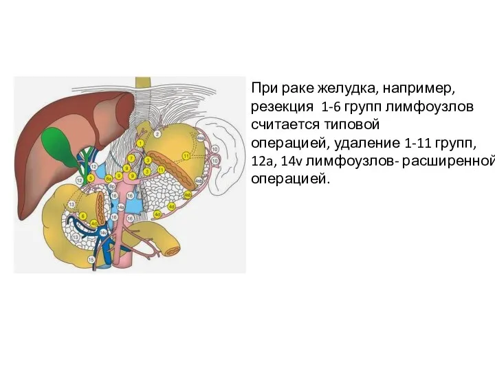 При раке желудка, например, резекция 1-6 групп лимфоузлов считается типовой операцией, удаление