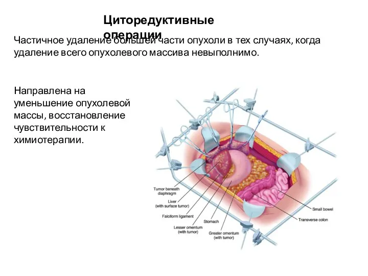 Частичное удаление большей части опухоли в тех случаях, когда удаление всего опухолевого