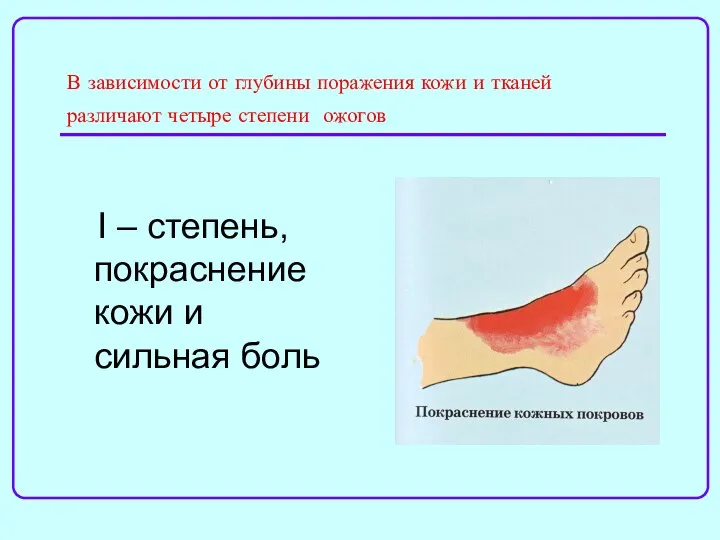 В зависимости от глубины поражения кожи и тканей различают четыре степени ожогов