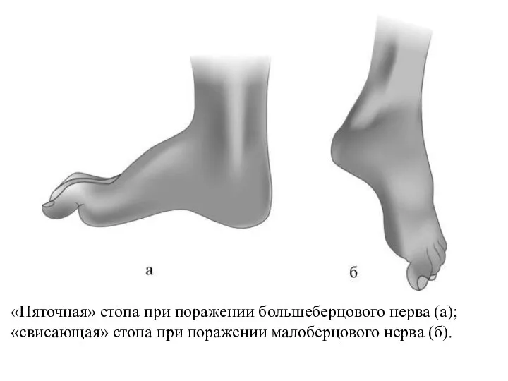 «Пяточная» стопа при поражении большеберцового нерва (а); «свисающая» стопа при поражении малоберцового нерва (б).