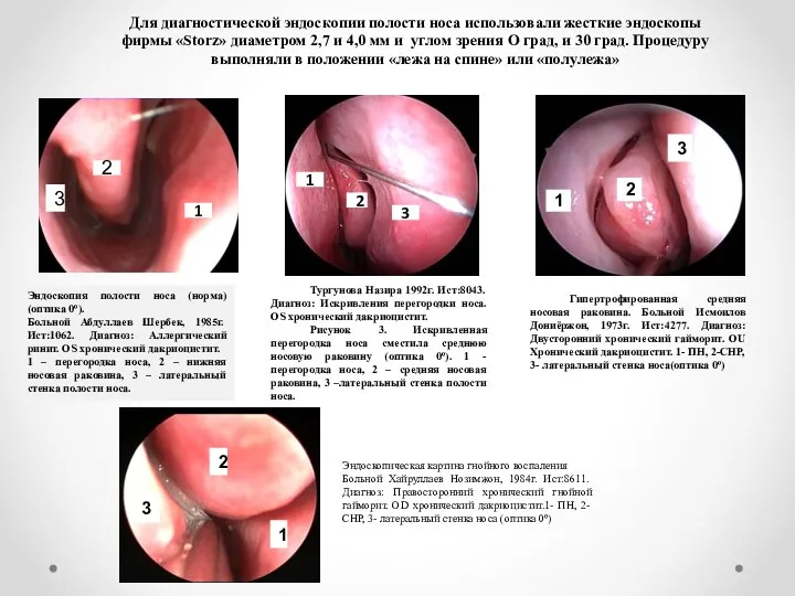 Эндоскопия полости носа (норма) (оптика 0º). Больной Абдуллаев Шербек, 1985г. Ист:1062. Диагноз: