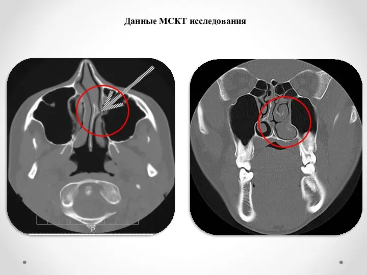 Данные МСКТ исследования