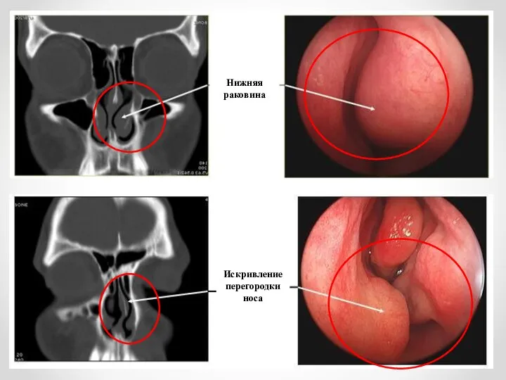носа, 2 Нижняя раковина Искривление перегородки носа