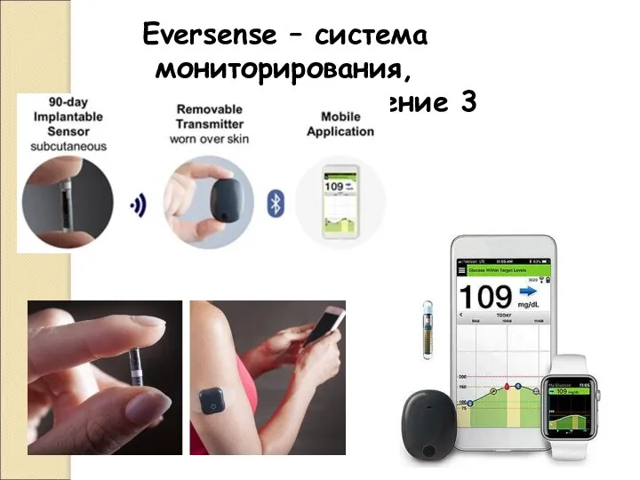 Eversense – система мониторирования, используемая в течение 3 месяцев