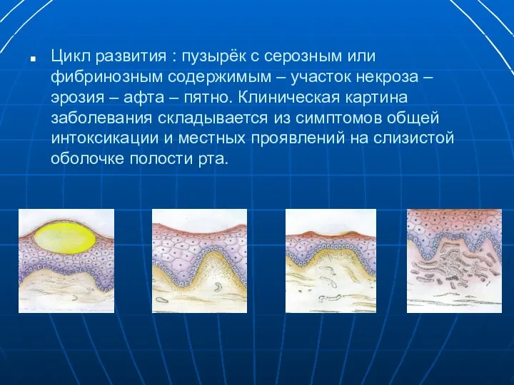 Цикл развития : пузырёк с серозным или фибринозным содержимым – участок некроза