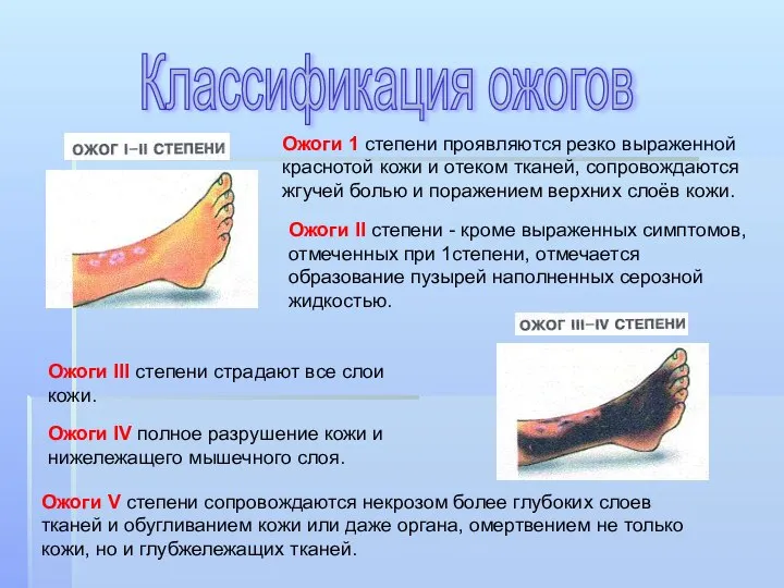 Ожоги 1 степени проявляются резко выраженной краснотой кожи и отеком тканей, сопровождаются