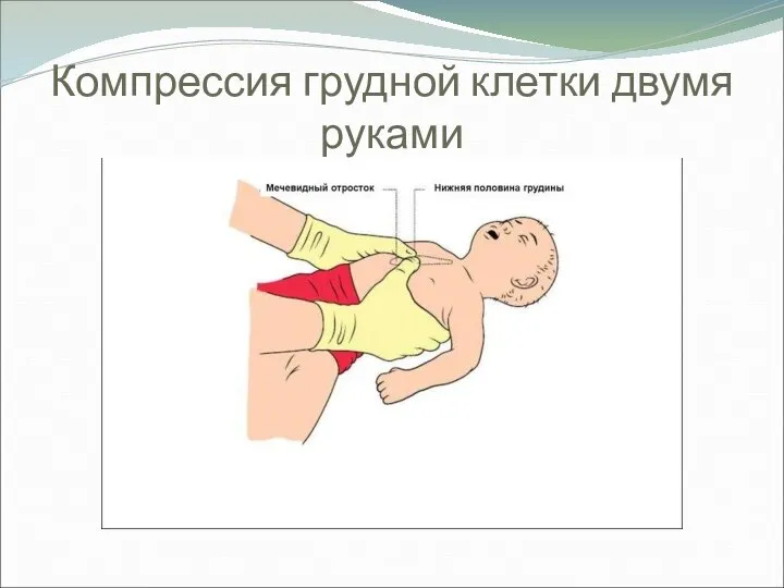 Компрессия грудной клетки двумя руками