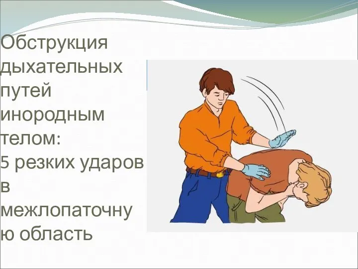 Обструкция дыхательных путей инородным телом: 5 резких ударов в межлопаточную область