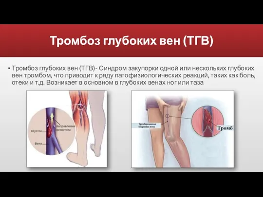 Тромбоз глубоких вен (ТГВ) Тромбоз глубоких вен (ТГВ)- Синдром закупорки одной или