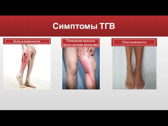 Симптомы ТГВ Боль в конечности Появление красных полос на коже возле вен Отек конечности