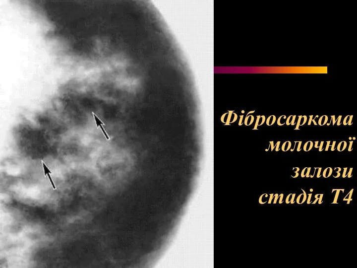 Фібросаркома молочної залози стадія Т4