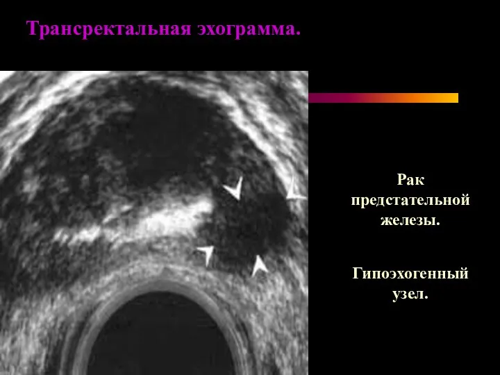 Рак предстательной железы. Гипоэхогенный узел. Трансректальная эхограмма.
