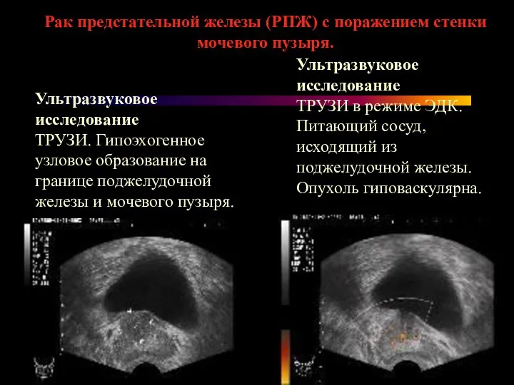 Рак предстательной железы (РПЖ) с поражением стенки мочевого пузыря. Ультразвуковое исследование ТРУЗИ.