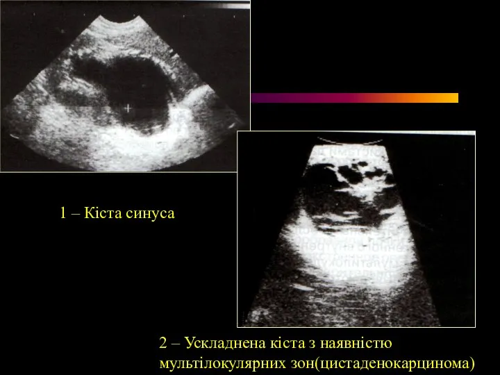 1 – Кіста синуса 2 – Ускладнена кіста з наявністю мультілокулярних зон(цистаденокарцинома)