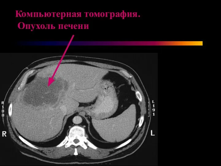 Компьютерная томография. Опухоль печени