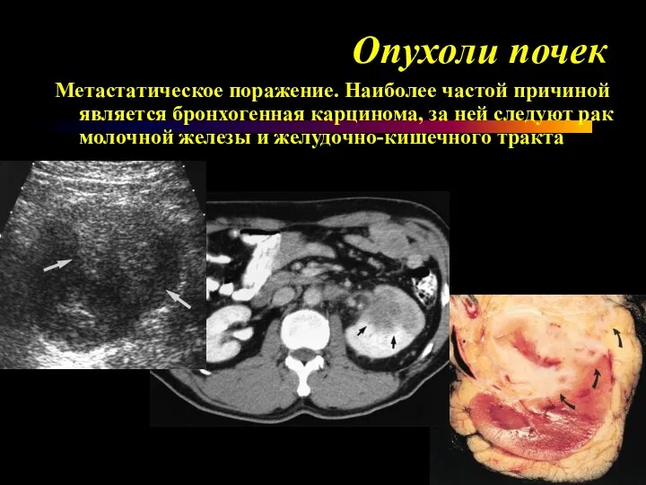 Опухоли почек Метастатическое поражение. Наиболее частой причиной является бронхогенная карцинома, за ней