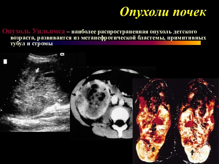 Опухоли почек Опухоль Уильямса – наиболее распространенная опухоль детского возраста, развивантся из