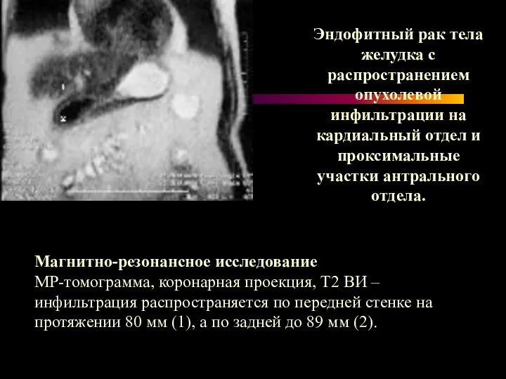 Магнитно-резонансное исследование МР-томограмма, коронарная проекция, Т2 ВИ – инфильтрация распространяется по передней