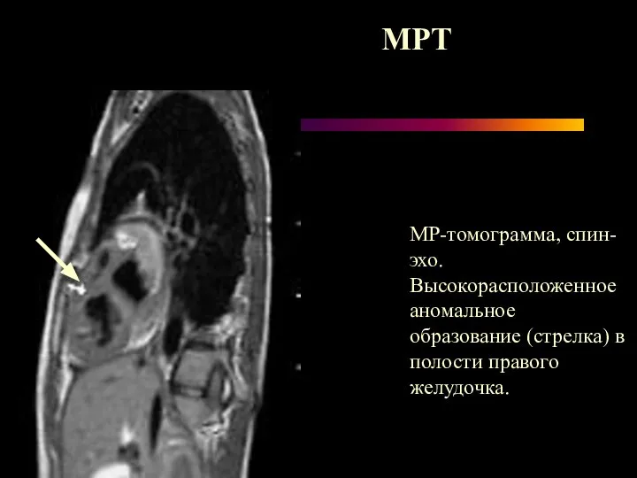 МР-томограмма, спин-эхо. Высокорасположенное аномальное образование (стрелка) в полости правого желудочка. МРТ