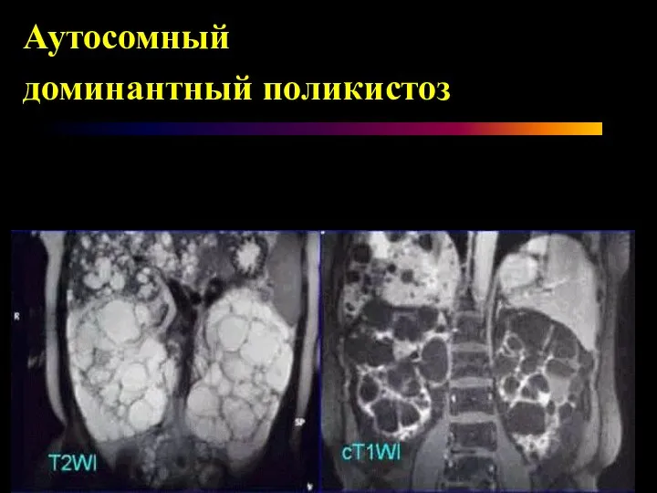 Аутосомный доминантный поликистоз