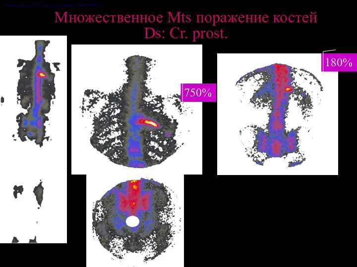 Опенько Возраст :65 Дата исследования: 12-06-02 №: 282 750% 180% Множественное Mts