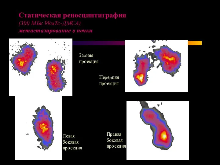 Статическая реносцинтиграфия (300 МБк 99мТс-ДМСА) метастазирование в почки Задняя проекция Передняяпроекция Левая