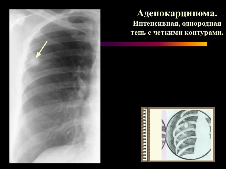 Аденокарцинома. Интенсивная, однородная тень с четкими контурами.