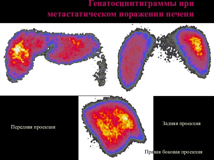 Гепатосцинтиграммы при метастатическом поражении печени Передняя проекция Задняя проекция Правая боковая проекция