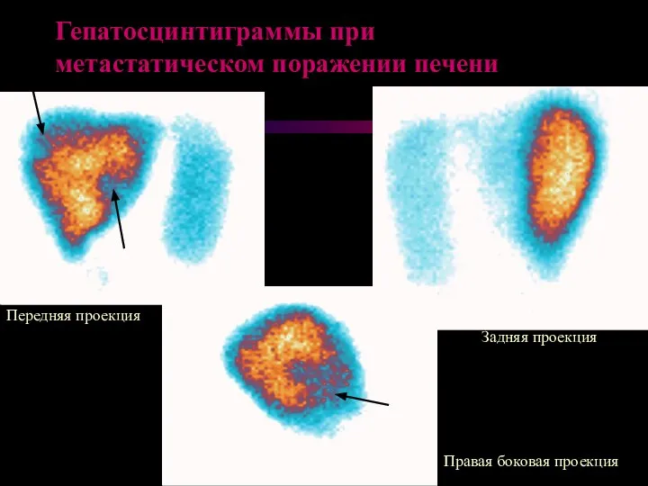 Гепатосцинтиграммы при метастатическом поражении печени Передняя проекция Задняя проекция Правая боковая проекция