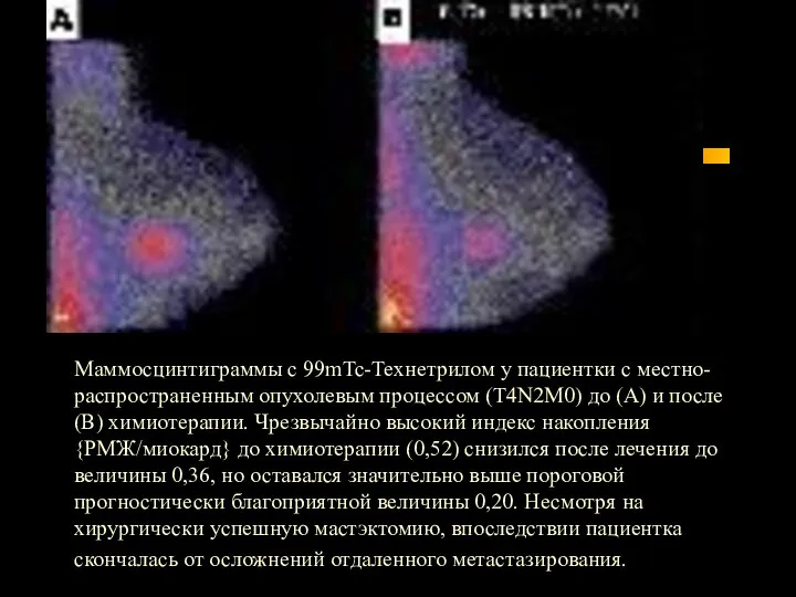 Маммосцинтиграммы с 99mTc-Технетрилом у пациентки с местно-распространенным опухолевым процессом (T4N2M0) до (А)