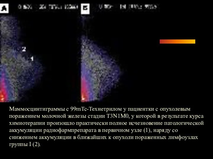 Маммосцинтиграммы с 99mTc-Технетрилом у пациентки с опухолевым поражением молочной железы стадии T3N1M0,