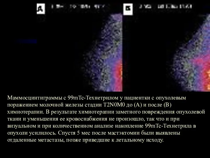 Маммосцинтиграммы с 99mTc-Технетрилом у пациентки с опухолевым поражением молочной железы стадии T2N0M0