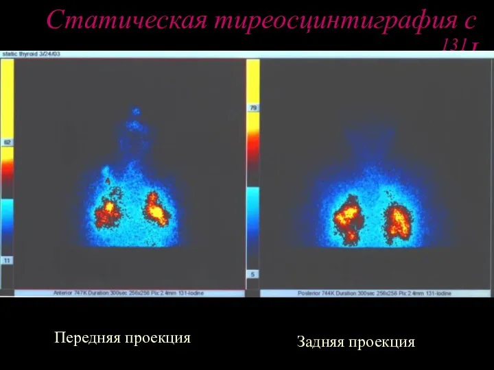 Статическая тиреосцинтиграфия с 131I Mts-поражение легких Передняя проекция Задняя проекция