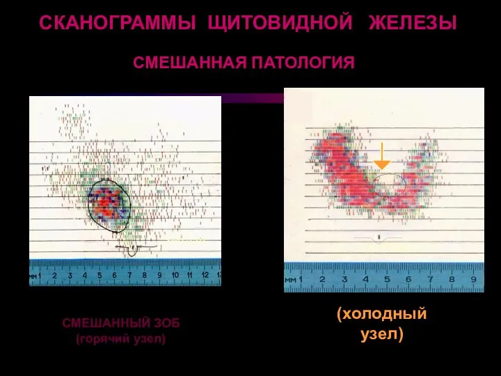 СМЕШАННАЯ ПАТОЛОГИЯ СМЕШАННЫЙ ЗОБ (горячий узел) (холодный узел) 2 S=27cm2 S=62cm2 СКАНОГРАММЫ ЩИТОВИДНОЙ ЖЕЛЕЗЫ