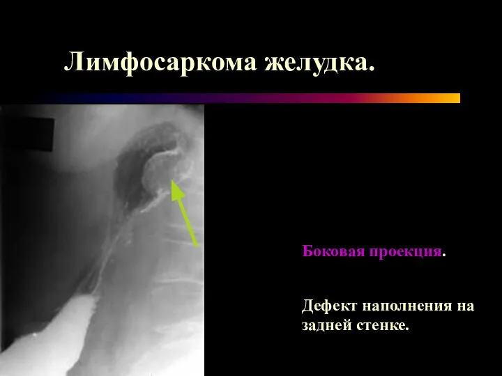 Лимфосаркома желудка. Боковая проекция. Дефект наполнения на задней стенке.