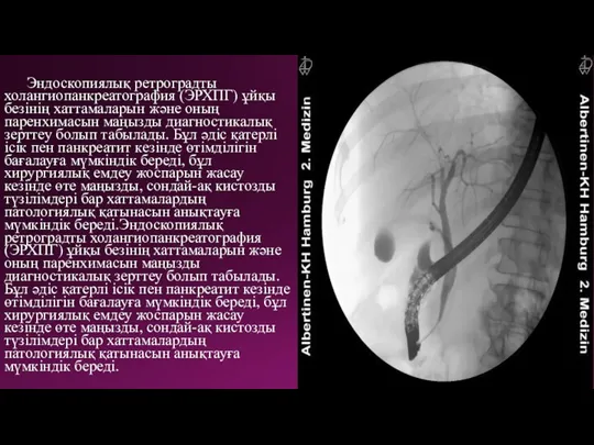 Эндоскопиялық ретроградты холангиопанкреатография (ЭРХПГ) ұйқы безінің хаттамаларын және оның паренхимасын маңызды диагностикалық
