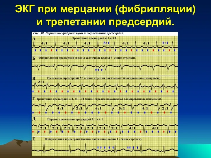 ЭКГ при мерцании (фибрилляции) и трепетании предсердий.