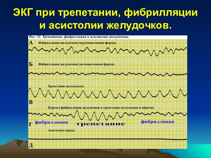 ЭКГ при трепетании, фибрилляции и асистолии желудочков.